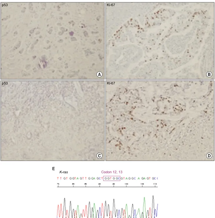 Fig. 4. Immunostaining of tumor. p53 and Ki-67 immunostaining (×100; A, B, common bile duct cancer; C, D, gallbladder cancer) and K-ras  mutation analysis (E)