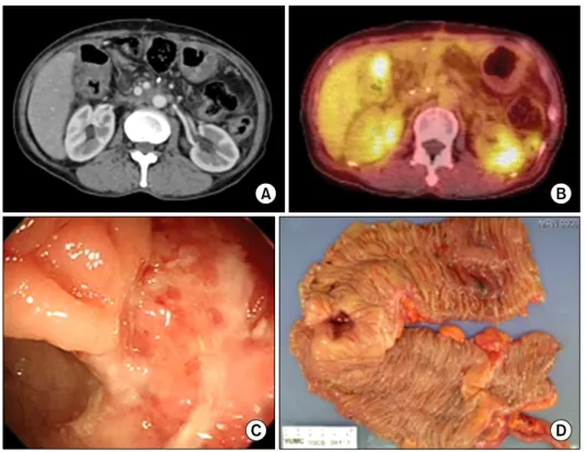 Fig. 5. Images of computed tomo- tomo-graphy (CT), positron emission  tomography (PET), colonoscopy  and gross specimen for a  com-plication caused by adjuvant  radia-tion therapy
