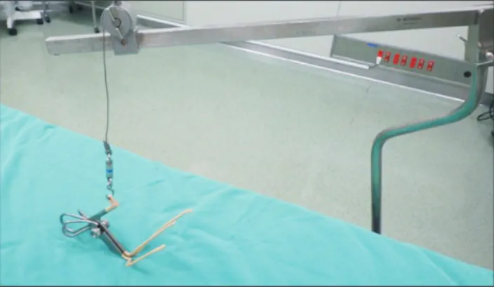 Fig. 1. A fan-shaped retractor is shown.