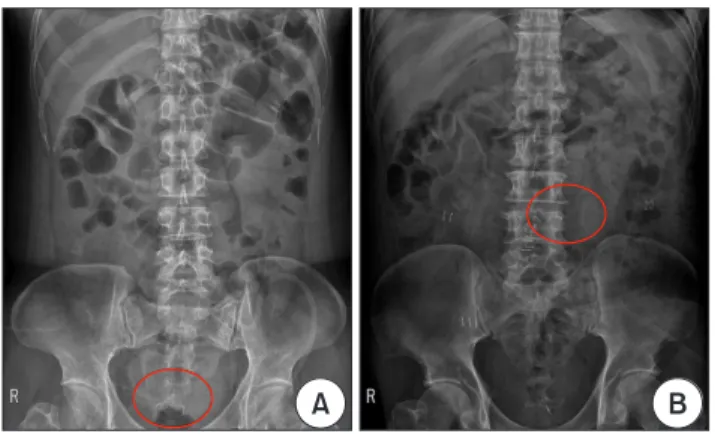 Fig. 2. Abdominal radiograph after surgery. (A) An example of a non- non-displaced drain and (B) a non-displaced drain.