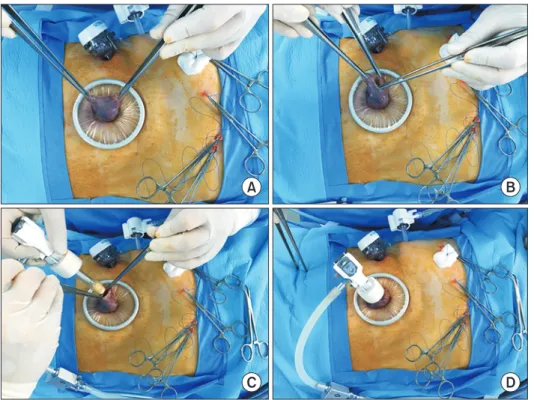 Fig. 1. Laparoscopic view of clamping the proximal margin. (A) A laparoscopic clamp is applied from the lesser curvature of the stomach at the expected  proximal resection margin