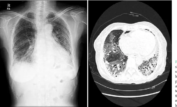 Fig. 2. A chest X-ray  showed increased  inter-stitial shadows in both  lungs and a chest  com-puted tomography scan  also revealed  aggrava-ted ground glass  opaci-ties and reticular  ho-neycomb lesions in both  lower lung fields.