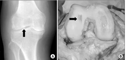 Fig. 1.  (A)  Translocation  of  the  lateral  tibial  spine  on  a  standing AP view of the knee