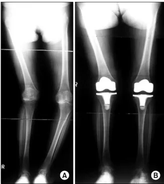 Fig. 2. (A) A 69 years old male demonstrate windblow knee deformity.  (B)  17  months  follow  up  x-ray  shows  good  alignment of the component.