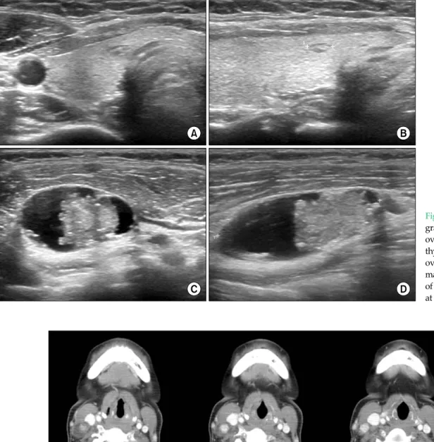 Fig. 1. Neck ultrasono- ultrasono-graphy shows a flat  ovoid 0.5 cm mass in the  thyroid (A, B) and an  oval 3.0 cm size solid  mass on the cystic wall  of the right lateral neck  at level III (C, D).