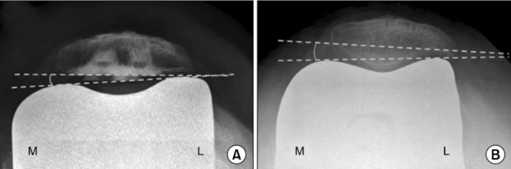 Table 1.  Patellar  Tracking  Patterns  of  Various  Implant  Types  Implants GG* TG † TTG ‡ TTTR § Total Genesis-II 7 38 16 1 62 Scorpio 24 52 26 4 106 Nexgen-LPS 13 34 9 0 56 PFC-RPF 0 1 0 0 1   Total 44 125 51 5 225