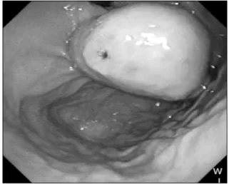 Fig. 2. Follow-up computed tomography shows metastasized mass  in the spleen.