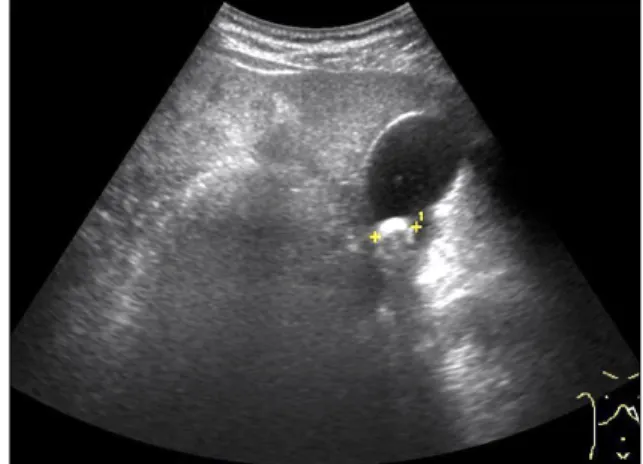 Fig. 4. Abdominal ultrasonography showed single dependent  echogenic foci with posterior acoustic shadowing consistent with  gallstone