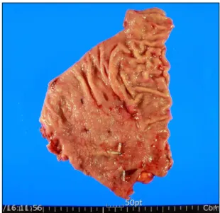 Fig. 9. Laparoscopic cholecystectomy was performed successfully  without injury of common bile duct