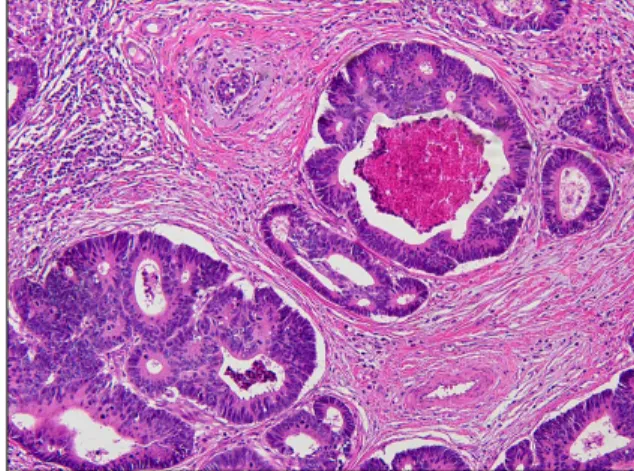 Fig. 2. 1.7 cm sized  irregular, whitish-gray,  firm mass was  iden-tified in lower inner  portion of right breast,  3.5 cm apart from  nip-ple