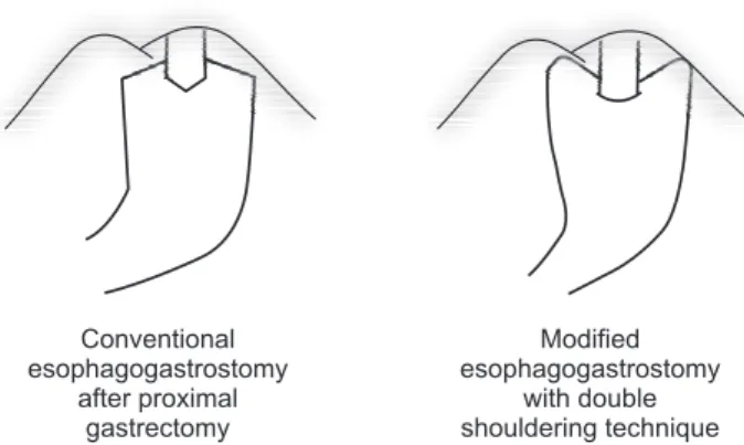 Fig. 1. Schematic of the double shouldering technique: Both sides of  proximal part of remnant stomach are anchored to the diaphragm by  simple sutures.