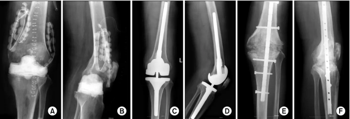 Fig. 1. Seventy nine-year-old male patient had infection after TKA. Six months after primary TKA, removal of implants and  insertion of antibiotic impregnated cement were performed (A, B)