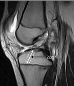 Fig. 2. Retrocutter drilling with retrograde force creates an  all-inside tibial socket.
