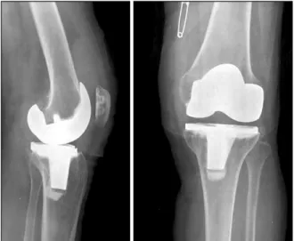 Fig. 1. Radiograph taken 1 year and 9 months after surgery. 
