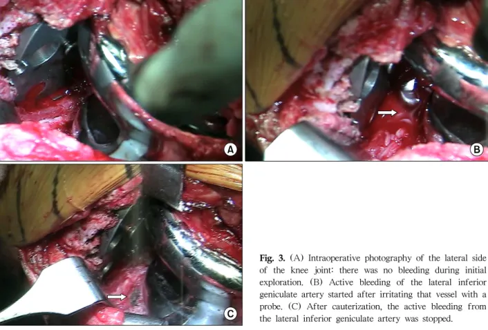 Fig. 3. (A) Intraoperative photography of the lateral side  of  the  knee  joint:  there  was  no  bleeding  during  initial  exploration