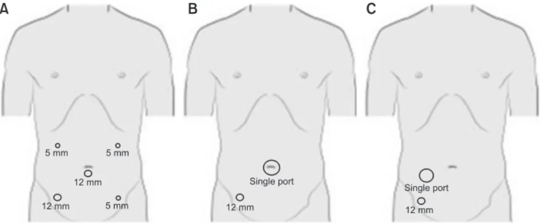 Fig. 1. Port placement for patient who  underwent multi-port laparoscopic low  anterior resection (M-LAR) (A), single  incision plus one port laparoscopic low  anterior resection (S+1-LAR) using  um-bilicus as main incision (B) and single  incision plus on