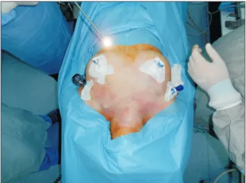 Fig. 1. Trocar insertion of BABA for endoscopic thyroidectomy.
