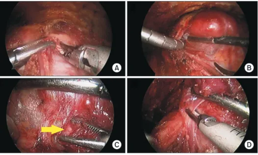 Fig. 2. Endoscopic view of BABA right  lobectomy. (A) Isthmus division, (B)  Thyroid mobilization with strap muscle  retraction, (C) Recurrent laryngeal nerve  identification (yellow arrow points to the  recurrent laryngeal nerve), (D) Superior  pole ligat