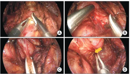 Table 2 describes the surgical variables and outcomes of each  method. In the BABA group, three patients underwent  lobec-tomy, and 29 underwent total thyroidectomy