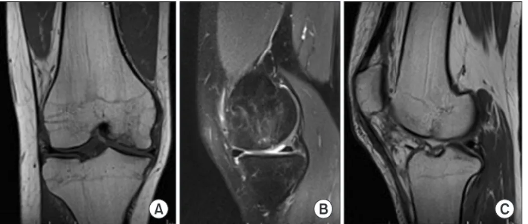 Fig. 3. Magnetic resonance imaging at  12­month follow­up. (A) Coronal T1  sequence showing adequate filling of the  defect, with the healing of the subchondral  bone