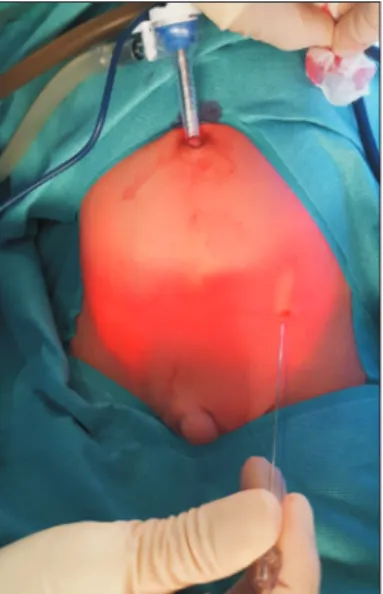 Fig. 1. Surgical preparation. A 4-0 Prolene  suture is inserted in a 21-G spinal needle.