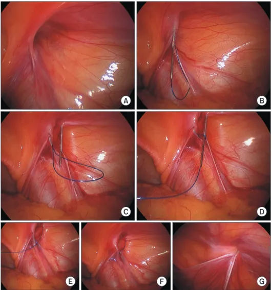 Fig. 3. Operative procedure. (A) An  open internal inguinal ring is identified. 