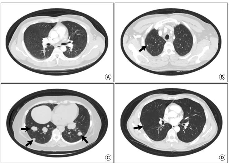 Fig. 1. Classification of the radiologic findings. (A) Normal. (B) Benign. (C) Metastatic