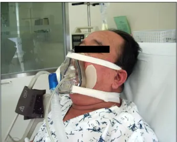 Fig. 1. Non-invasive ventilation.