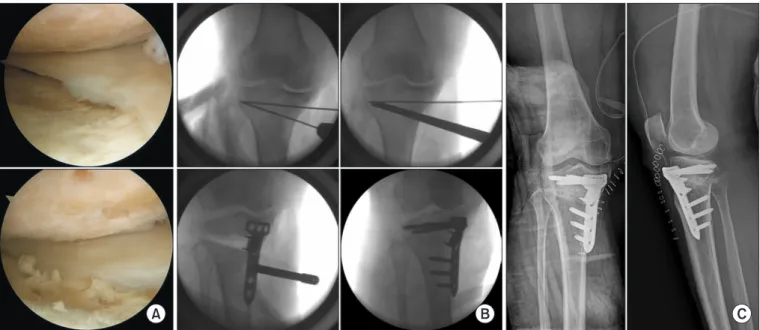 Fig. 2. (A) Vascular computed tomography  angiography performed three days after  surgery showing a pseudoaneurysm of  the popliteal artery at the level of proximal  screw fixation