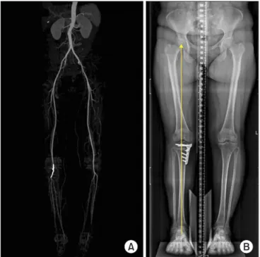 Fig. 4. Postoperative 8­month vascular computed tomography (CT) an­
