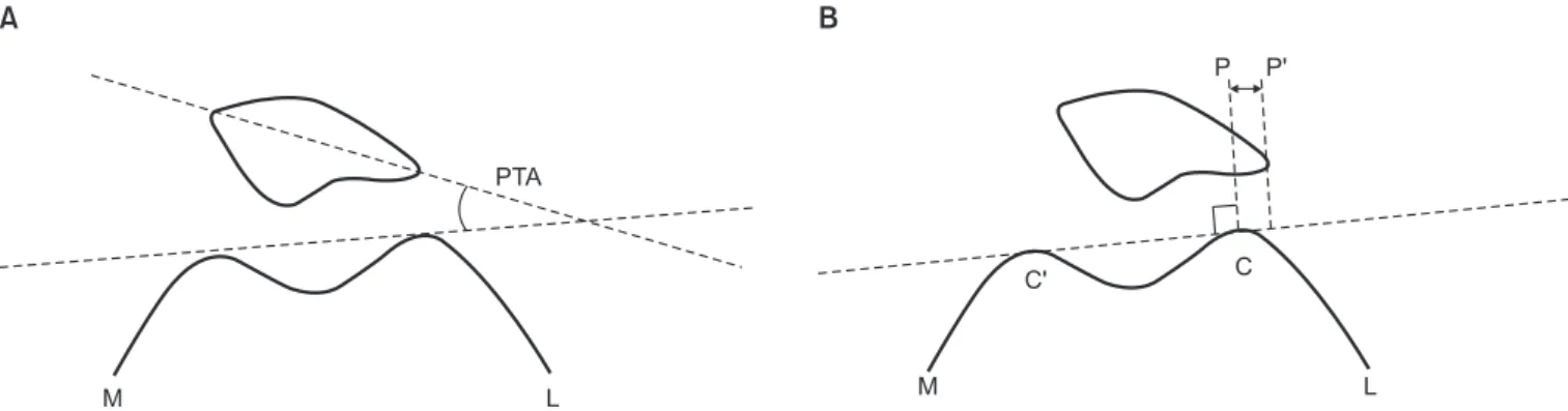 Fig. 1. (A) Measurement of patellar tilting angle (PTA). PTA was defined as the angle between a line intersecting the widest bony structure of the  patella and a line tangent to the anterior surface of the femoral condyles on a skyline view