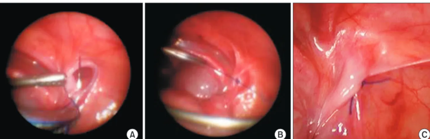 Fig. 2. Intracorporeal purse-string suture. The internal ring was sewn with a purse-string suture while avoiding the visceral injury (A)