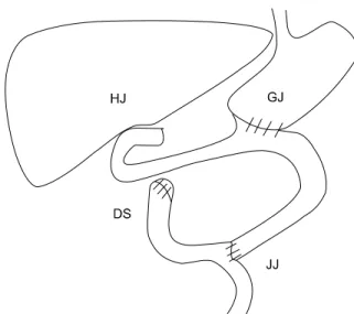 Fig. 7. This shows schematic drawing after laparoscopic distal  gastrectomy. HJ, hepaticojejunostomy; GJ, gastrojejunostomy, DS,  duodenal stump; JJ, jejunojejunostomy.