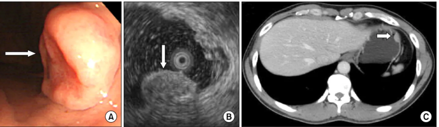 Fig. 1. (A) The endoscopic study revealed a 1.5 cm ovoid, elevated lesion with a central hyperemic depression on the anterior side of the high body