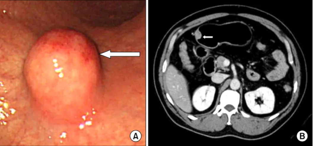Fig. 4. (A) The endoscopic finding  shows the submucosal tumor with  normal mucosa on the greater  curvature side of the proximal  antrum, about 2 cm in size