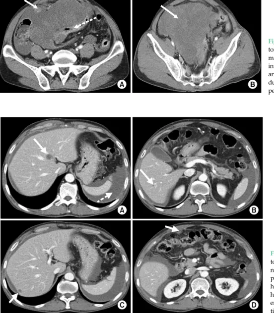 Fig. 2. Pre-operative computed  tomography findings. (A) Arrow,  nodule on liver S4; Dotted arrow,  perisplenic hematoma