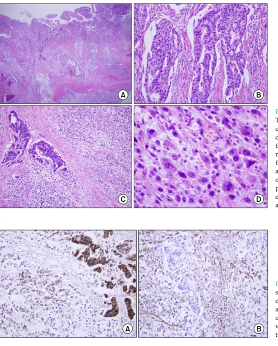 Fig. 3. Histological findings. (A)  The tumor was composed of two  components. (B) The  adenocar-cinoma area was located mainly in the luminal surface and was  moderately differentiated