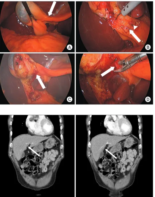 Fig. 2. Cystic artery originated from  seg ment IV hepatic artery (arrow).