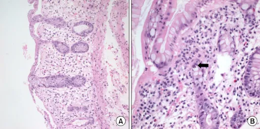 Fig. 1.  Colonic biopsy specimen  from patient shows acute graft  versus host disease (GVHD)