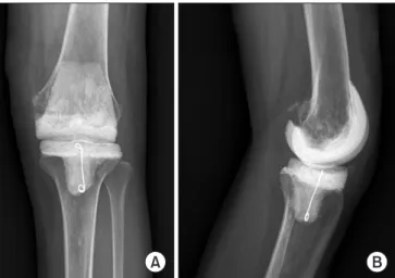 Fig. 2. A static spacer is inserted and it is augmented by intramedullary  extension using a Steinmann pin or broken nail