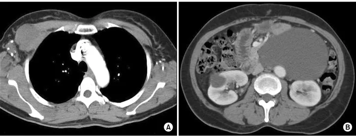 Fig. 1. (A) Chest computed tomography (CT) shows multifocal soft tissue masses with calcification in the bilateral axillae, right pectoralis  muscle, intermuscular layer of the left posterolateral chest wall