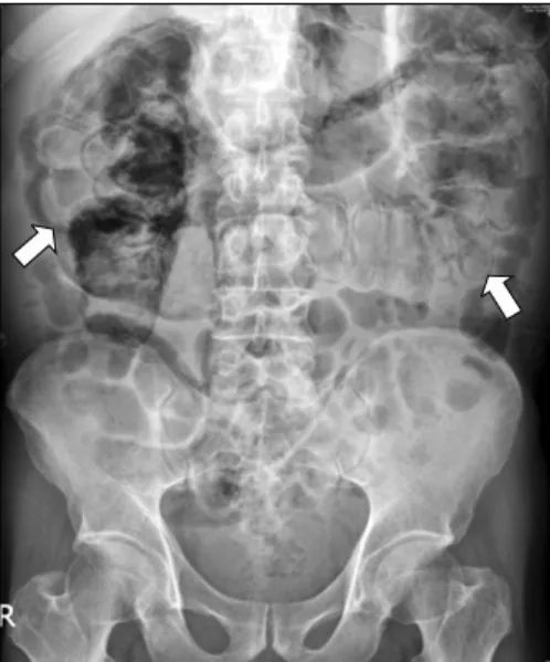 Fig. 1. Plain film of abdomen shows diffuse linear intramural air  (arrows) along cecum to proximal descending colon.