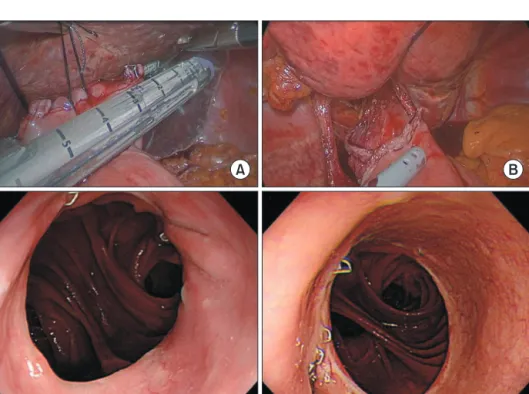 Fig. 1. Closure of esophagojejunostomy  with the overlap method with stapled  closure (A, B) and postoperative  endo-scopic finding (C, D).