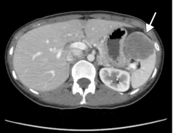 Fig. 1. Preoperative abdominal computed tomography demon- demon-strates an expansible low density mass (white arrow).