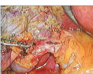 Fig. 1. Needlescopic grasper assisted single incision laparoscopic cho- cho-lecystectomy (nSILC) nSILC was performed through a SILS port with a  snake liver retractor, ENDOPATH ®  electrosurgery probe plus system, and  2 mm needlescopic grasper