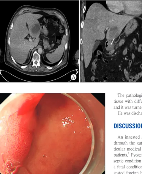 Fig. 1. (A) 5.8 cm sized rim enhanced  hypodense mass at left hepatic lobe  (hepatic abscess)