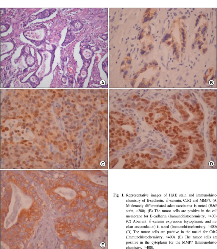 Fig. 1. Representative  images  of  H&amp;E  stain  and  immunohisto- immunohisto-chemistry  of  E-cadherin,  β-catenin,  Cdx2  and  MMP7