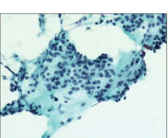 Fig.  1.  Cytologic  findings  of  neck  mass.  Fine  needle  aspiration  cy- cy-tology  was  performed  for  neck  mass  with  suspected  thyroid  tumor