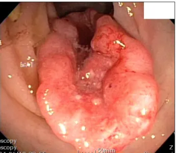 Fig. 1. At colonoscopy, an ulcerofungating moderately differentiated adenocarcinoma measuring 3.5×3.5 cm was seen in the  sigmoid colon.