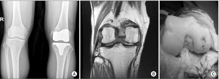 Fig. 1. (A) Radiograph showing proximal tibial vara in the right knee and previous total knee arthroplasty status of the left knee